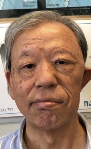 Facial Palsy Eyelid Surgery